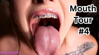 Braces Mouth Tour 4