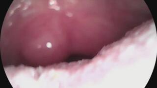 Deepthroat-endo