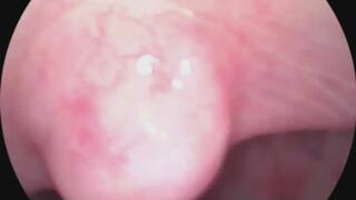 Let's take a ride down my throat with my endoscope!!