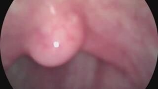 lets take an endoscope tour around the mouth and uvula