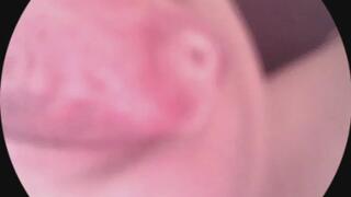 Uvula with drool