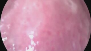 Endoscope- uvula, throat, mouth