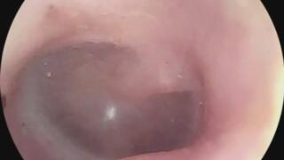 is that the ear drum!!! endoscope view