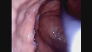 Bailey Swallows Pineapple Chunks (STOMACH ENDOSCOPE)