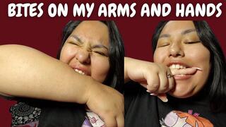 Bites on my arms and hands