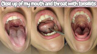 Close up of my mouth and throat with tonsillitis