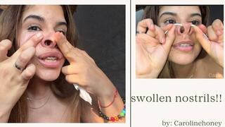 My nose is very swollen