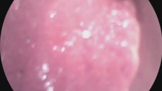 endoscope glittery lips!